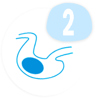 paso 2-balon-gastrico-con-fondo-forma